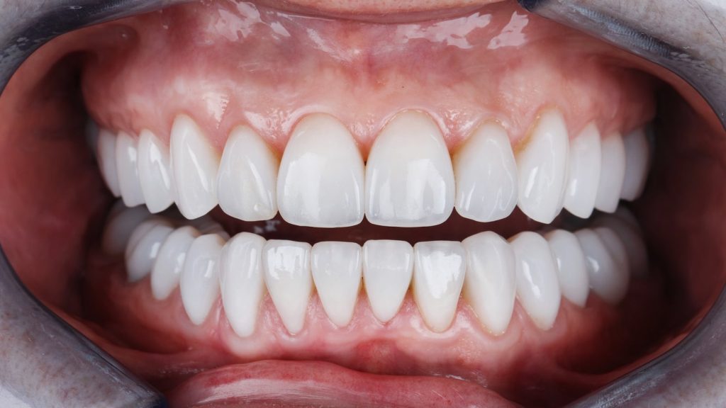 Transform Your Smile with Porcelain Veneers
