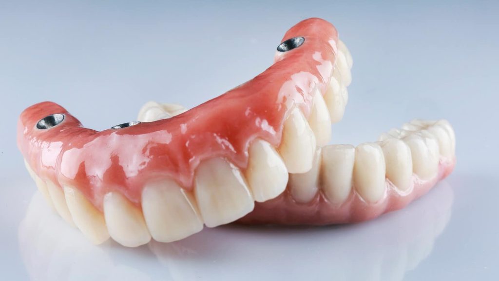 Dental Bridge