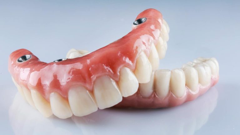 Dental Bridge